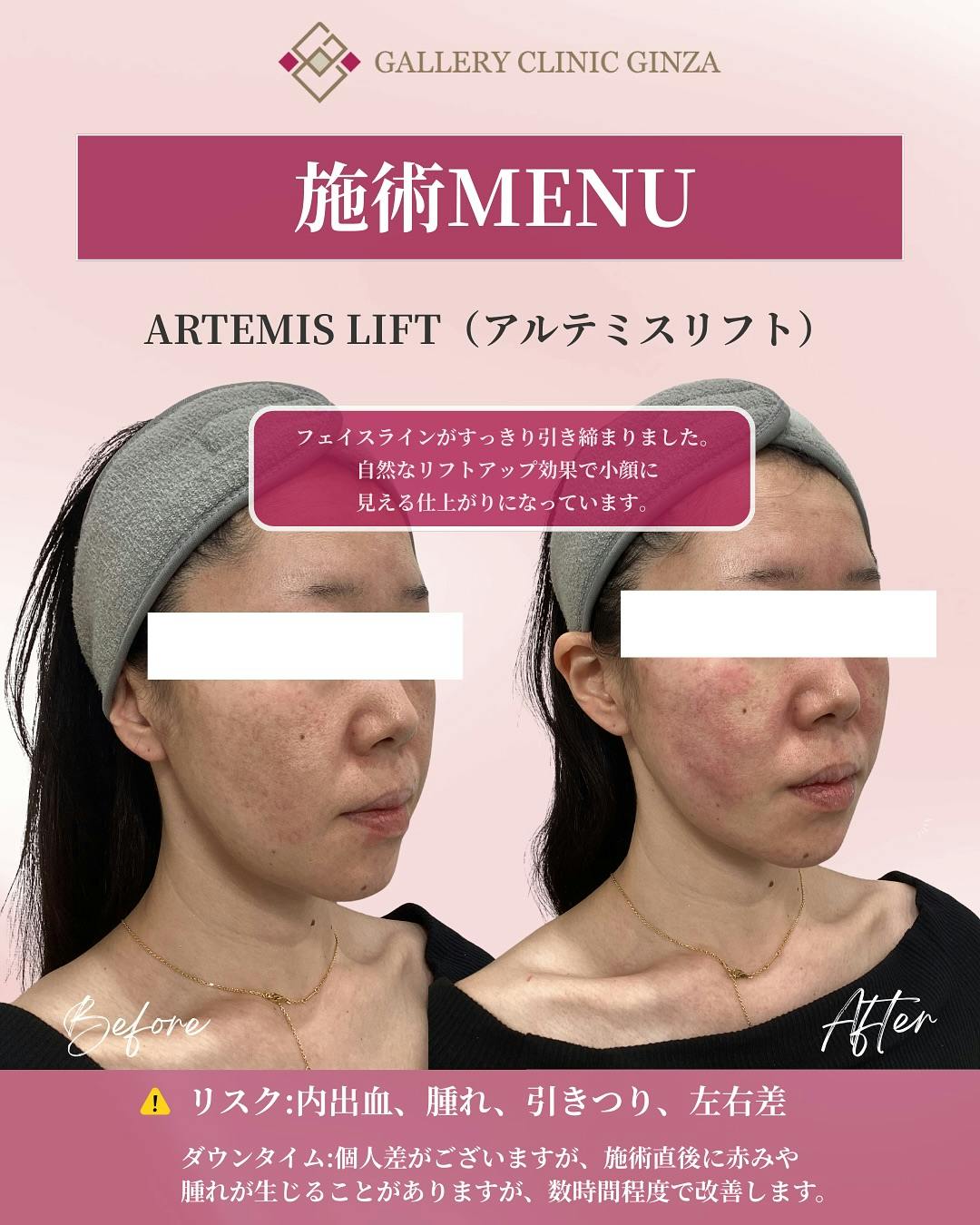 【女性・輪郭】アルテミスリフト_before_aftar