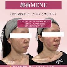 【女性・輪郭】アルテミスリフト_before_aftar