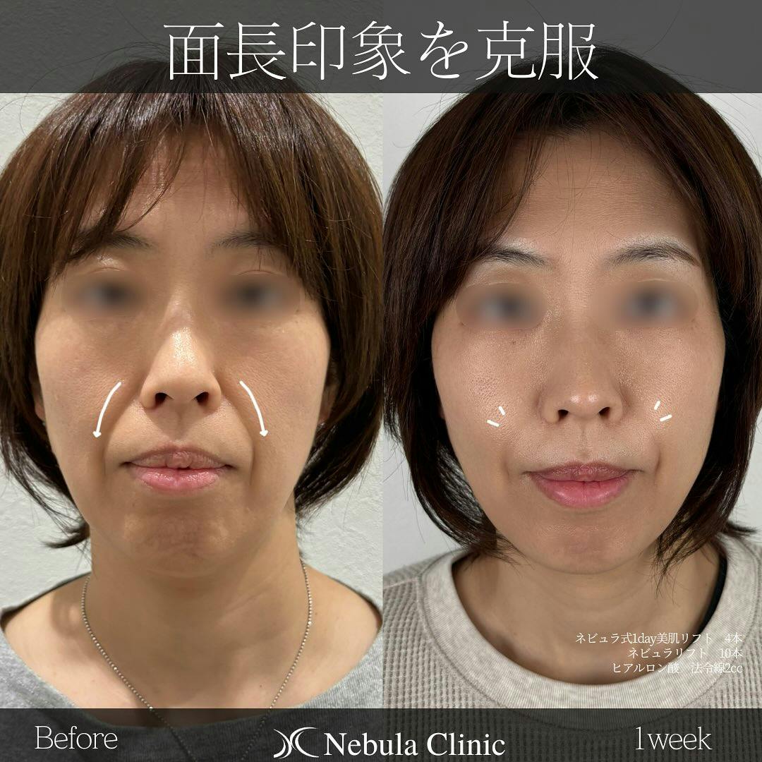 【女性・ほうれい線】糸リフト、ヒアルロン酸注入_before_aftar