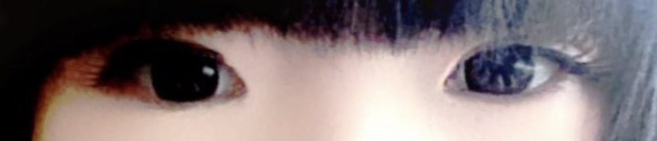 銀座高須クリニックで目頭切開・眼瞼下垂・二重全切開を受けたのえるさんの写真