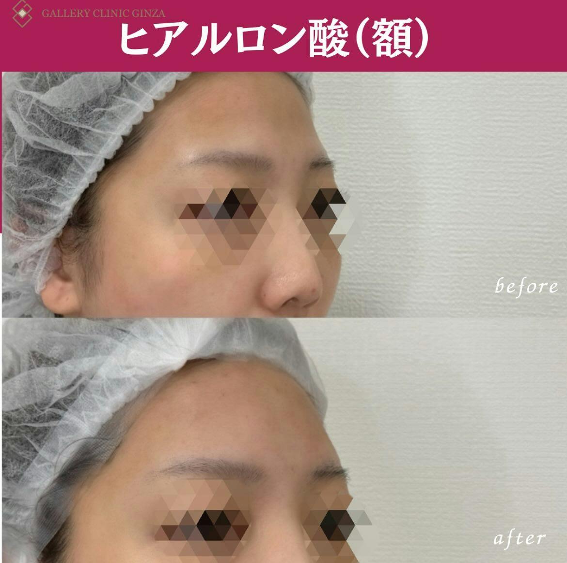 【女性・額】ヒアルロン酸(額)_before_aftar