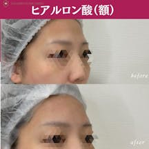 【女性・額】ヒアルロン酸(額)_before_aftar