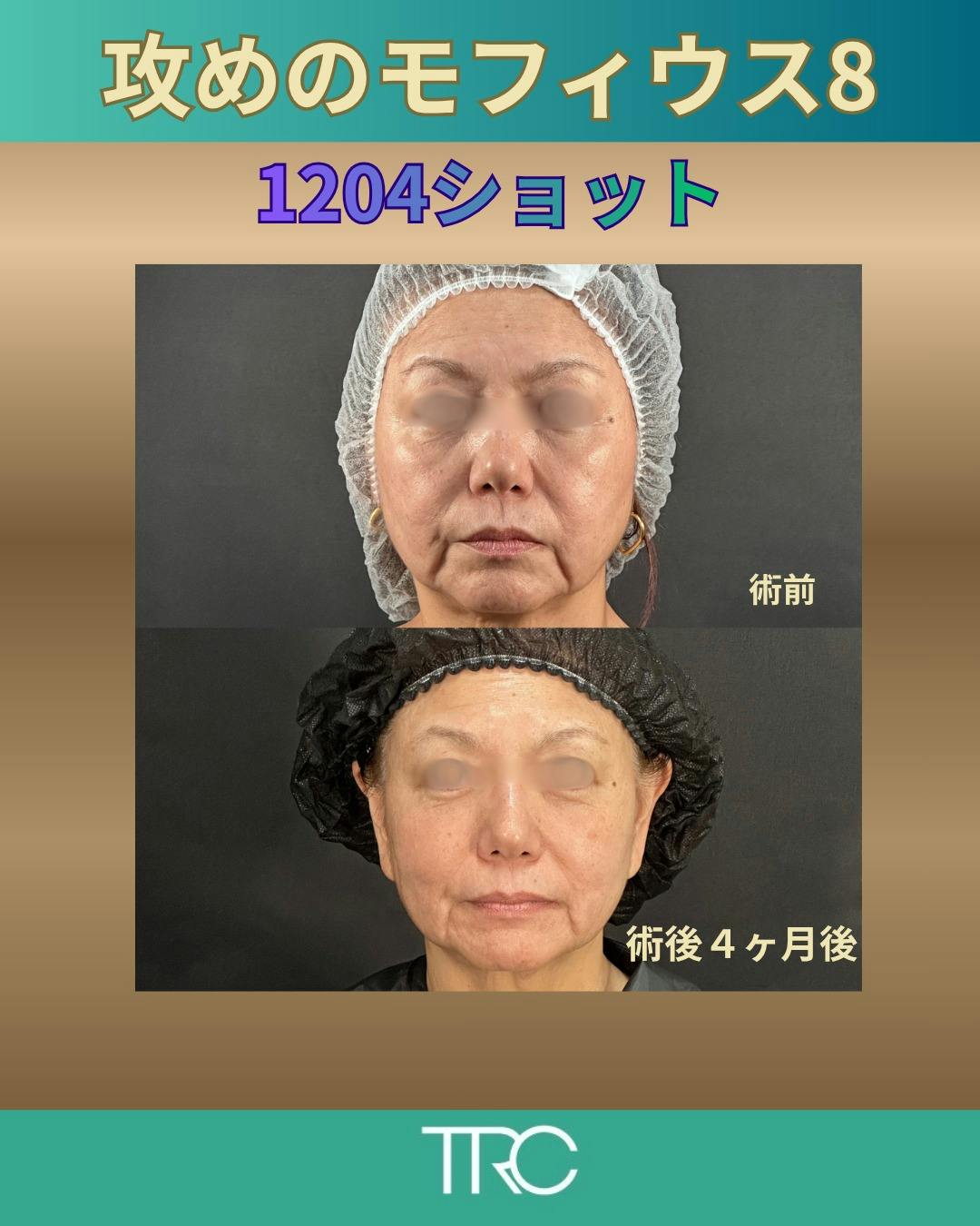 【60代女性・顔】攻めのモフィウス8_before_aftar