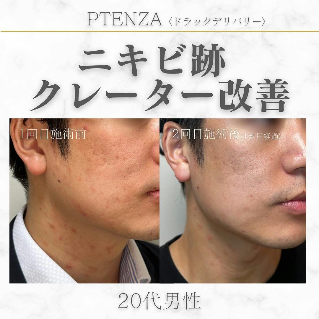 【男性20代・ニキビ跡】ポテンツァ ドラッグデリバリー_before_aftar