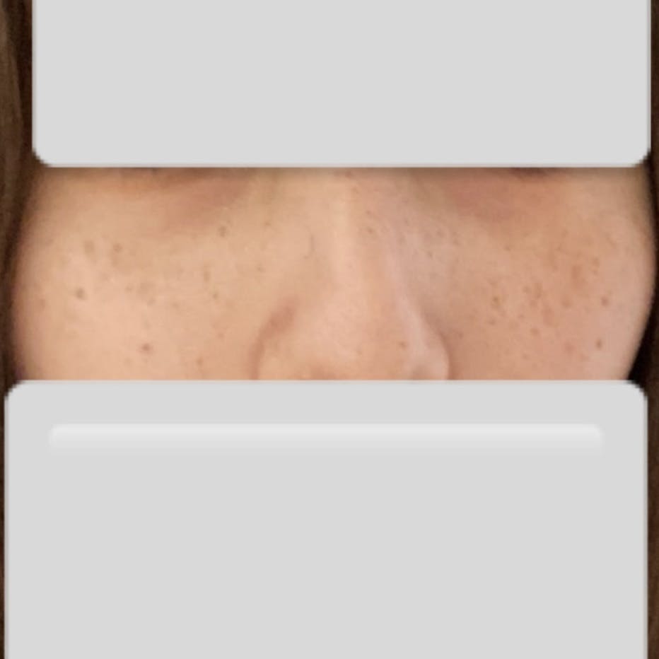 南青山トクナカクリニック(南青山TOKUNAKAクリニック)でルビーレーザー(Qスイッチルビーレーザー)・医療レーザー治療を受けたねこさんの写真