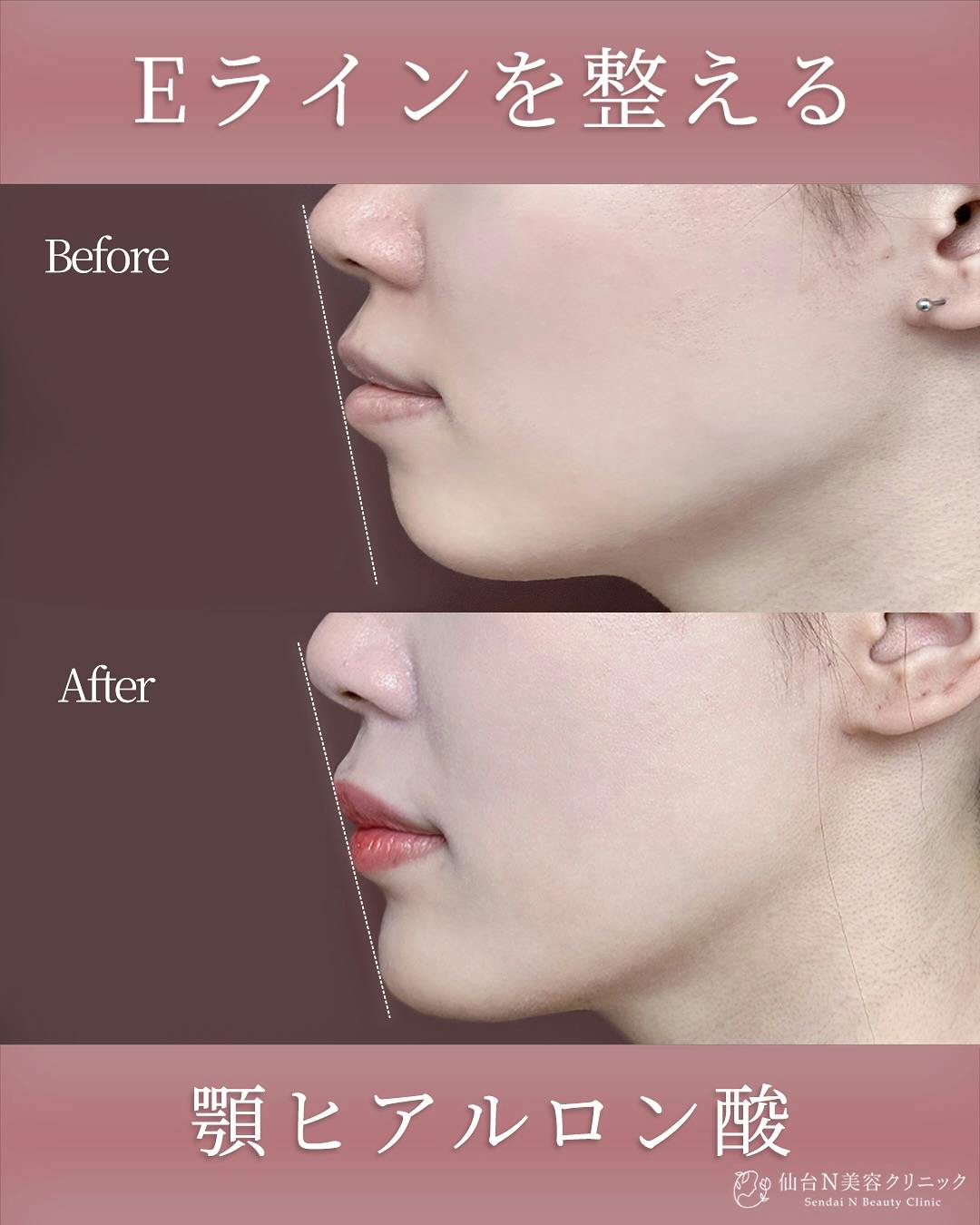 【女性・顎】ヒアルロン酸 ボラックス_before_aftar