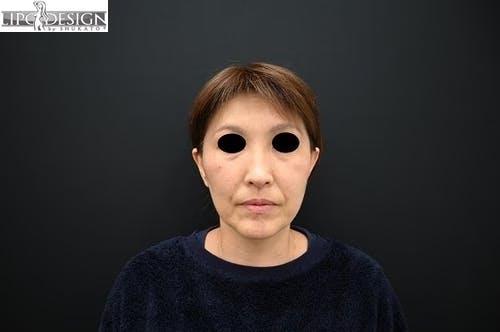 【49歳女性・輪郭】SBCプレミアムPRP皮膚再生療法_before