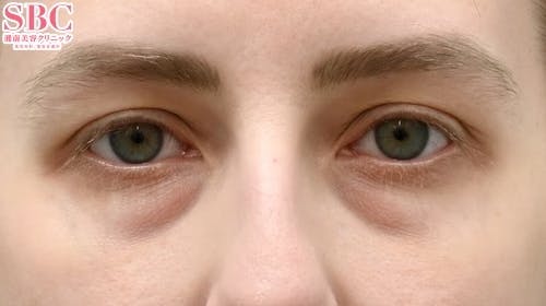 【女性・目元】目の下の切らないクマ・たるみ（ふくらみ）取り、ナチュラル脂肪注射コンデンスリッチ、ナチュラル脂肪注射ナノリッチ_before