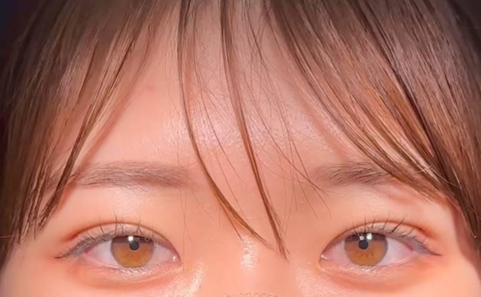 ルラ美容クリニック 渋谷本院で二重埋没法：1dayルラライン二重術を受けた相原さんの写真