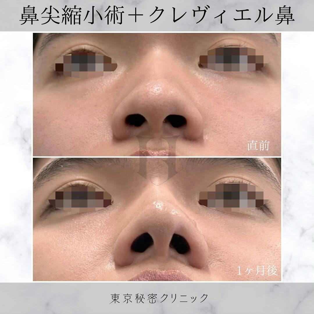 【女性・鼻】鼻先縮小術_before_aftar