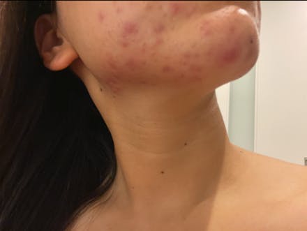 MILDIX SKIN CLINIC(ミルディス皮フ科 北千住院)でを受けたえりすけさんの写真