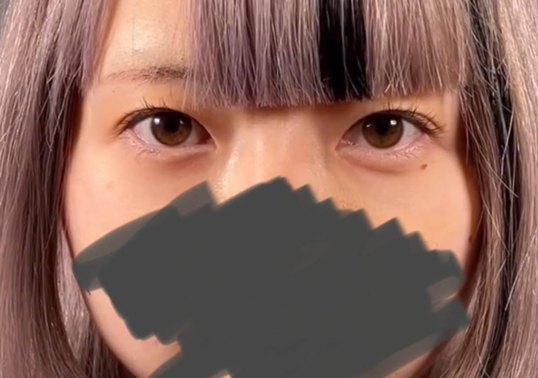 品川美容外科上野院で二重整形：二重術ナチュラル法（二重埋没法）3点留めを受けたOMUさんの写真
