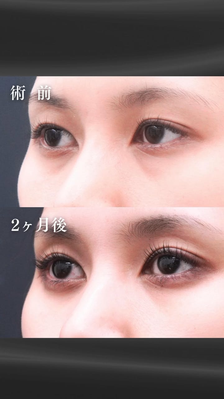 【32歳女性・目元】経結膜脱脂術・眼窩脂肪注入_before_aftar
