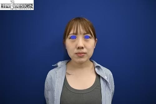 【24歳女性・小顔】バッカルファット_1week