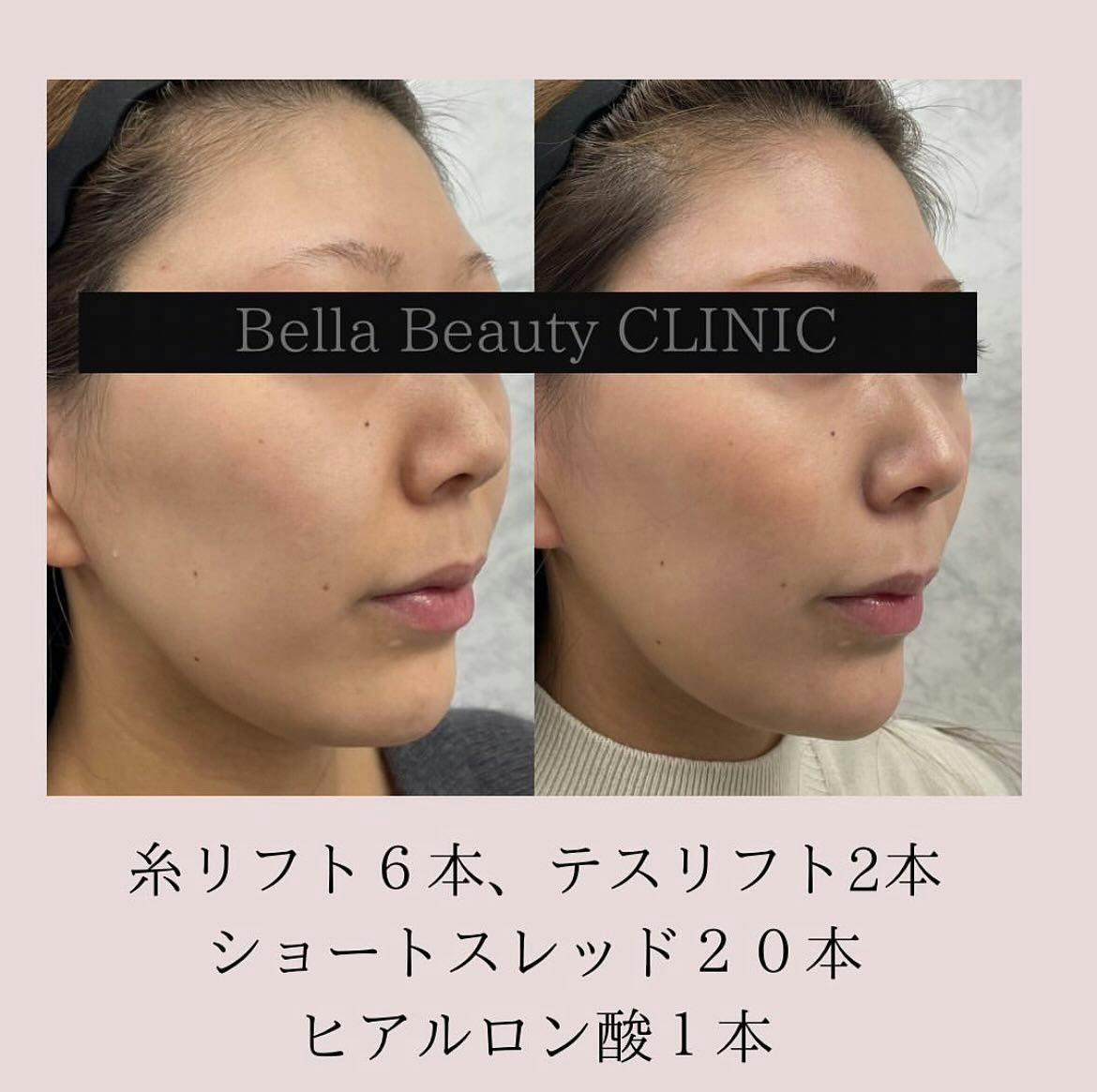 【女性・輪郭】糸リフト（フェイスライン）_before_aftar