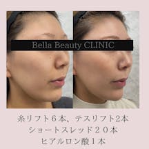 【女性・輪郭】糸リフト(フェイスライン)_before_aftar