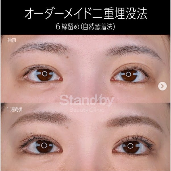 【女性・目元】オーダーメイド二重埋没法　6線留め(自然癒着法)_before_aftar