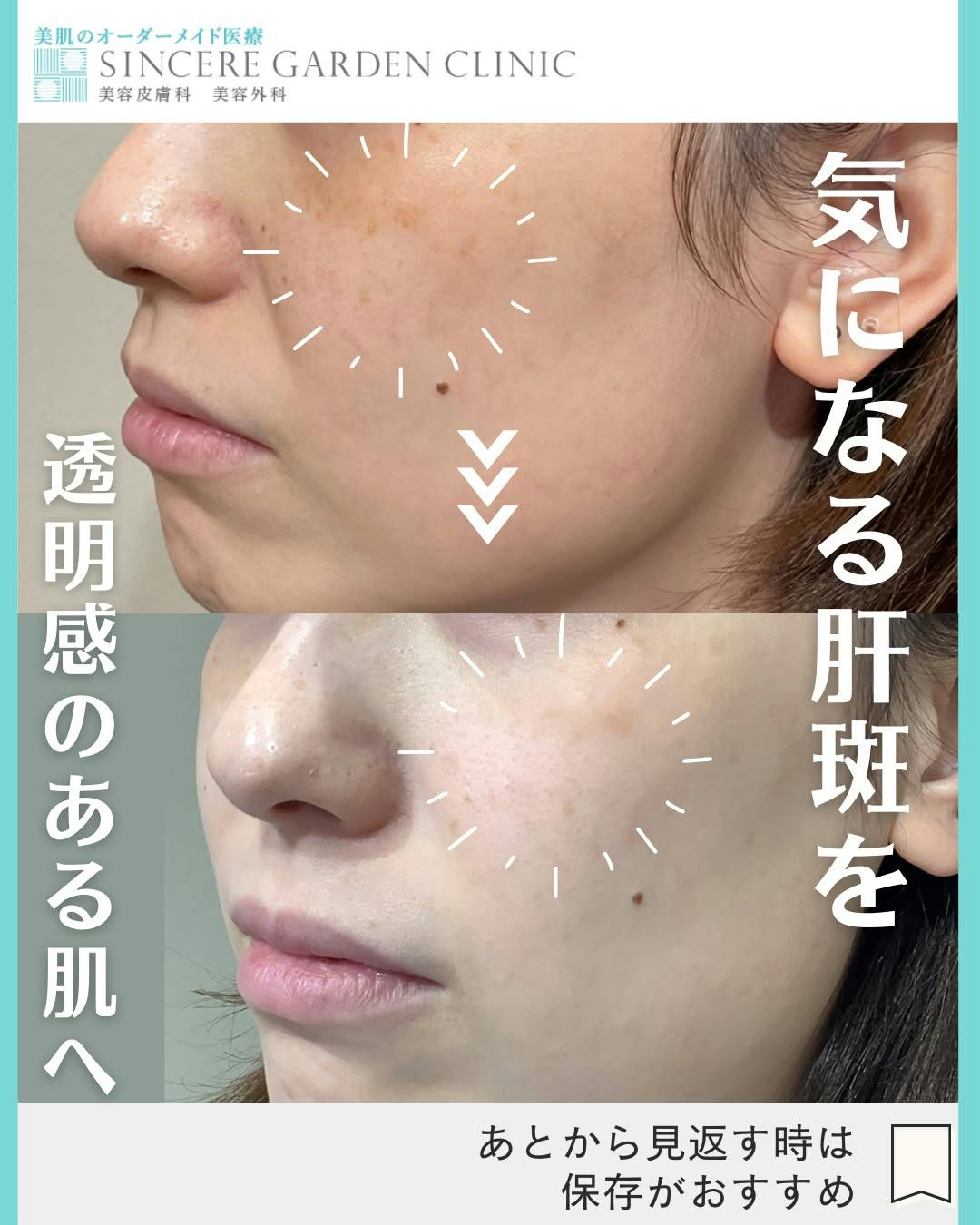 【女性・肝斑】レーザートーニング_before_aftar