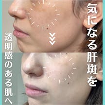 【女性・肝斑】レーザートーニング_before_aftar