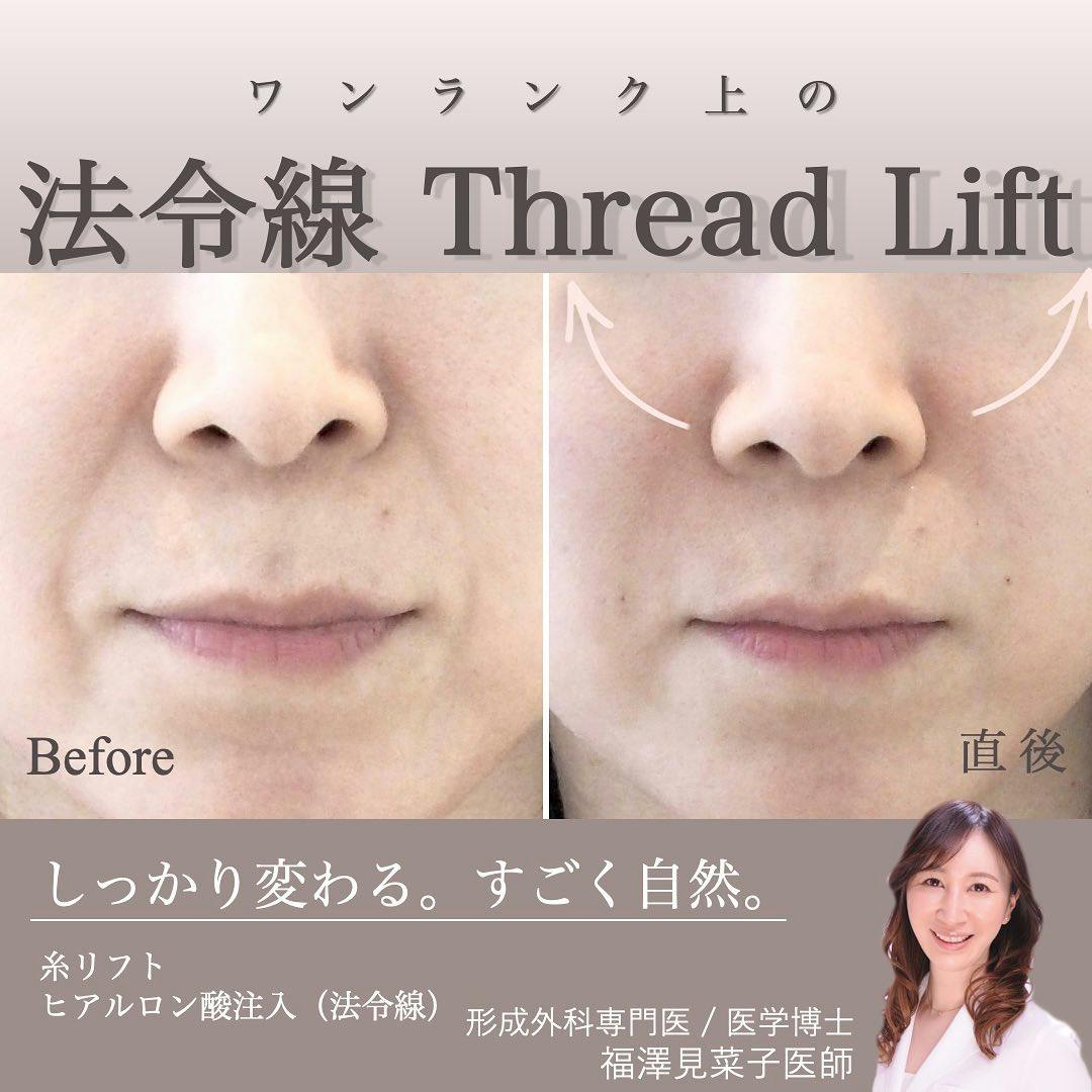 【女性・法令線】糸リフト、ヒアルロン酸注入（法令線）_before_aftar