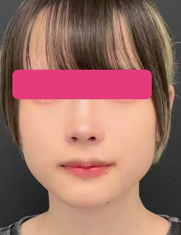 湘南美容クリニック 横浜院で鼻尖形成術（だんご鼻解消術）：鼻尖形成術3D法を受けた400TBさんの写真