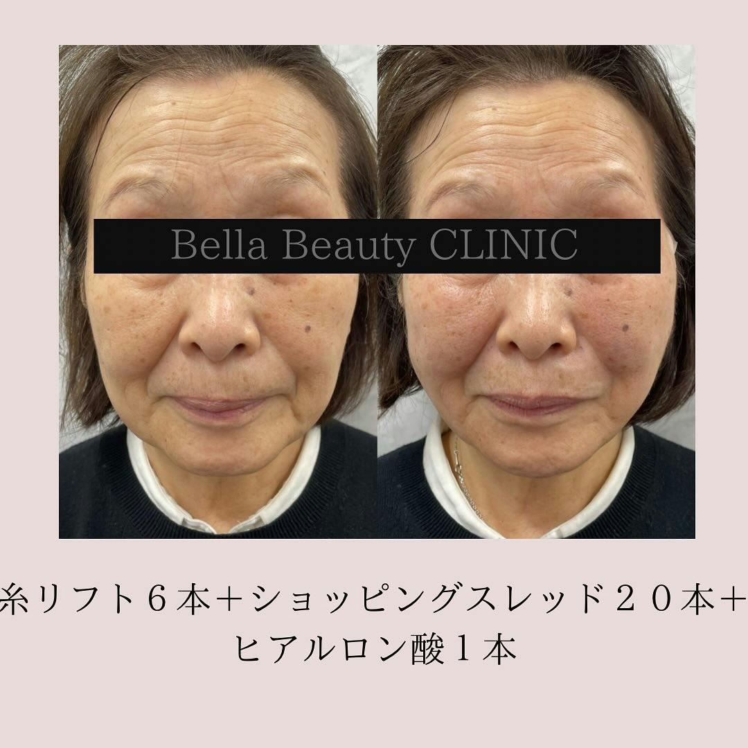 【女性・たるみ】糸リフト　フェイスライン_before_aftar