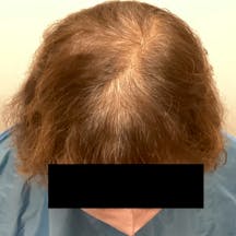 【65歳女性・頭髪】薄毛治療_before