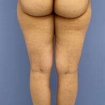 【女性・下半身】Aquicell(アキーセル)脂肪吸引、根こそぎVASER脂肪吸引_before