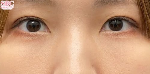 【女性・クマ】目の下の切らないクマ・たるみ（ふくらみ）取り ナチュラル脂肪注射コンデンスリッチ ナチュラル脂肪注射ナノリッチ_after