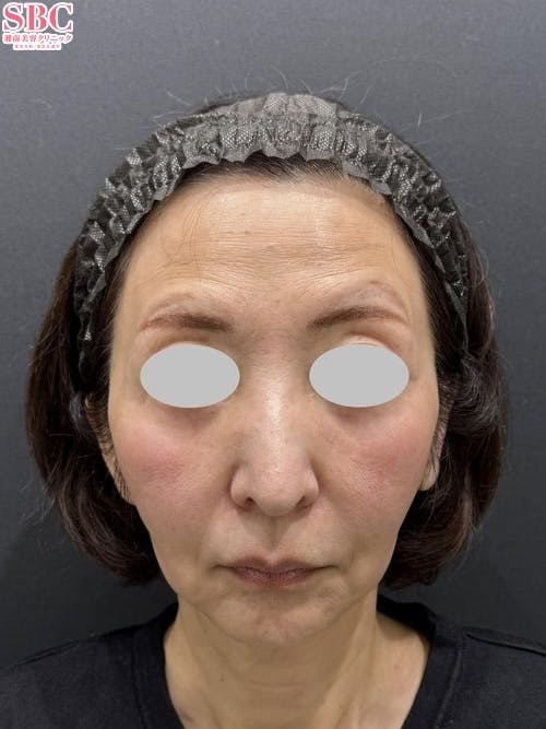 【60代女性・たるみ】スマスフェイスリフト_before