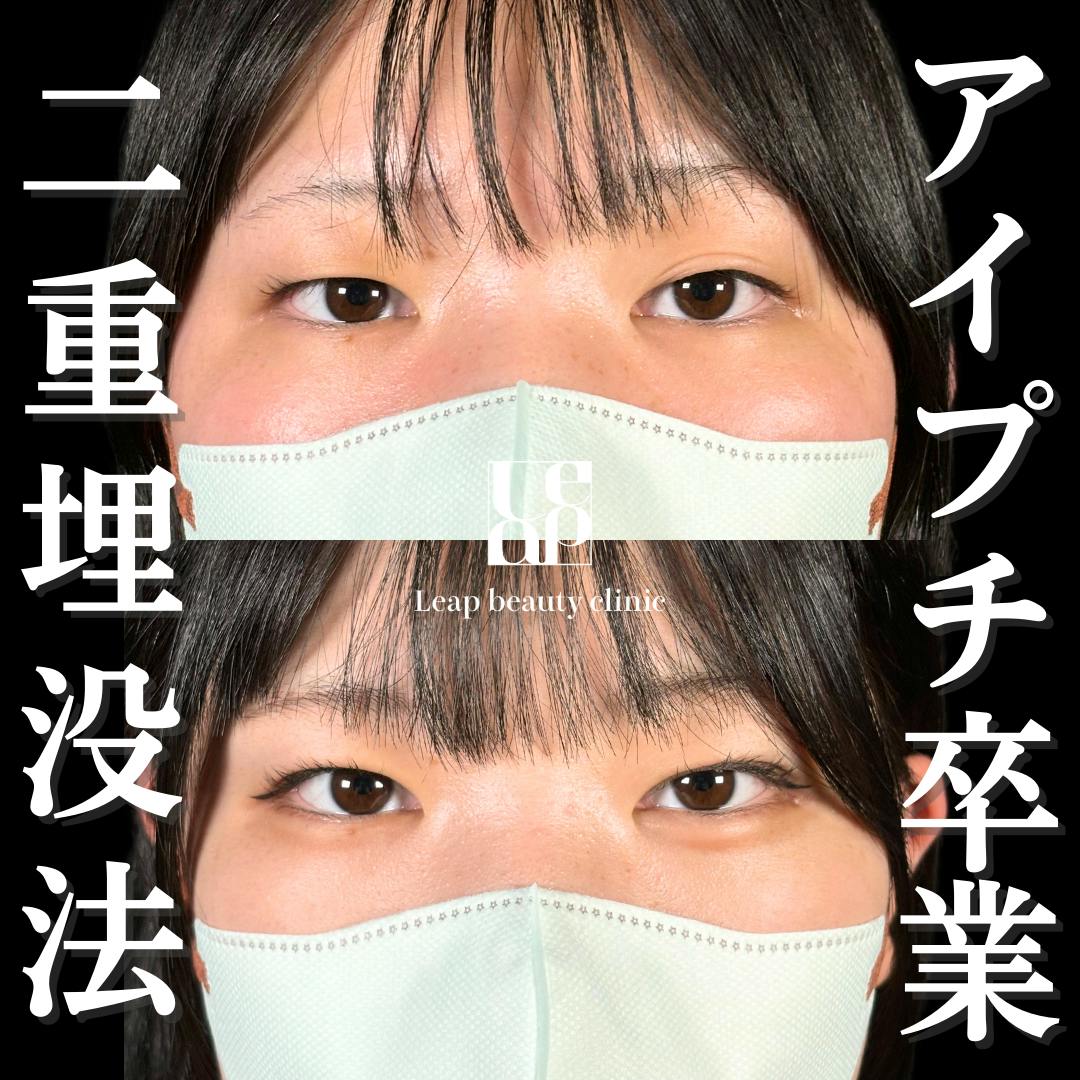 【10代女性・目元】二重埋没法_before_aftar