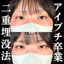 【10代女性・目元】二重埋没法_before_aftar