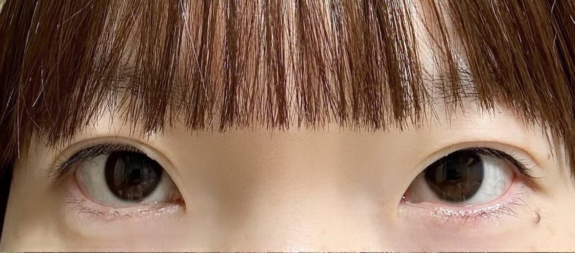 湘南美容クリニック 横浜院で二重全切開法、目頭切開を受けたナカノさんの写真