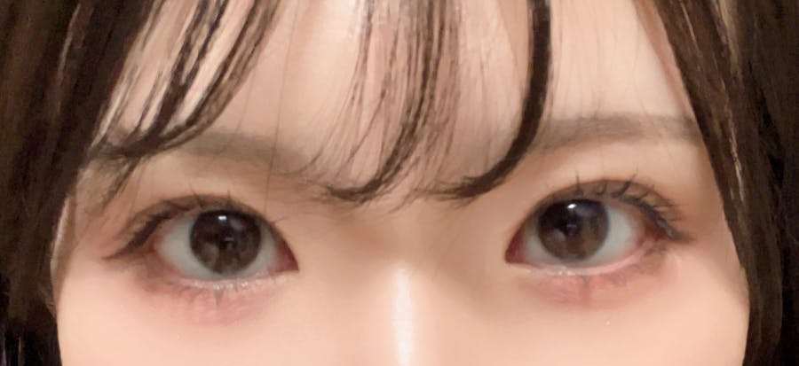 シンデレラ・アンド・ダヴィンチクリニック(Cinderella & Da Vinci Clinic)でを受けたなななさんの写真