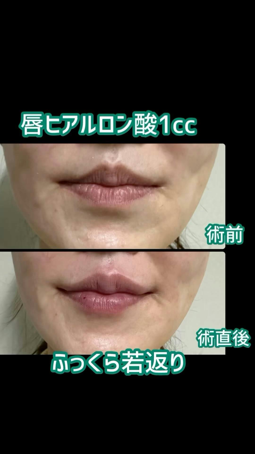 【女性・唇】唇ヒアルロン酸_before_aftar