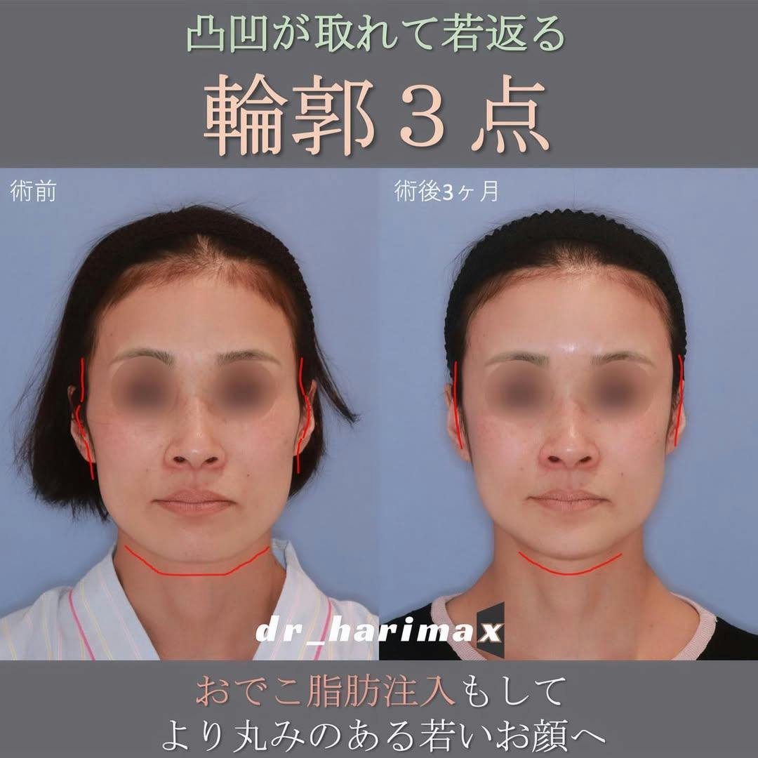 【女性・顔】輪郭3点・おでこ脂肪注入_before_aftar