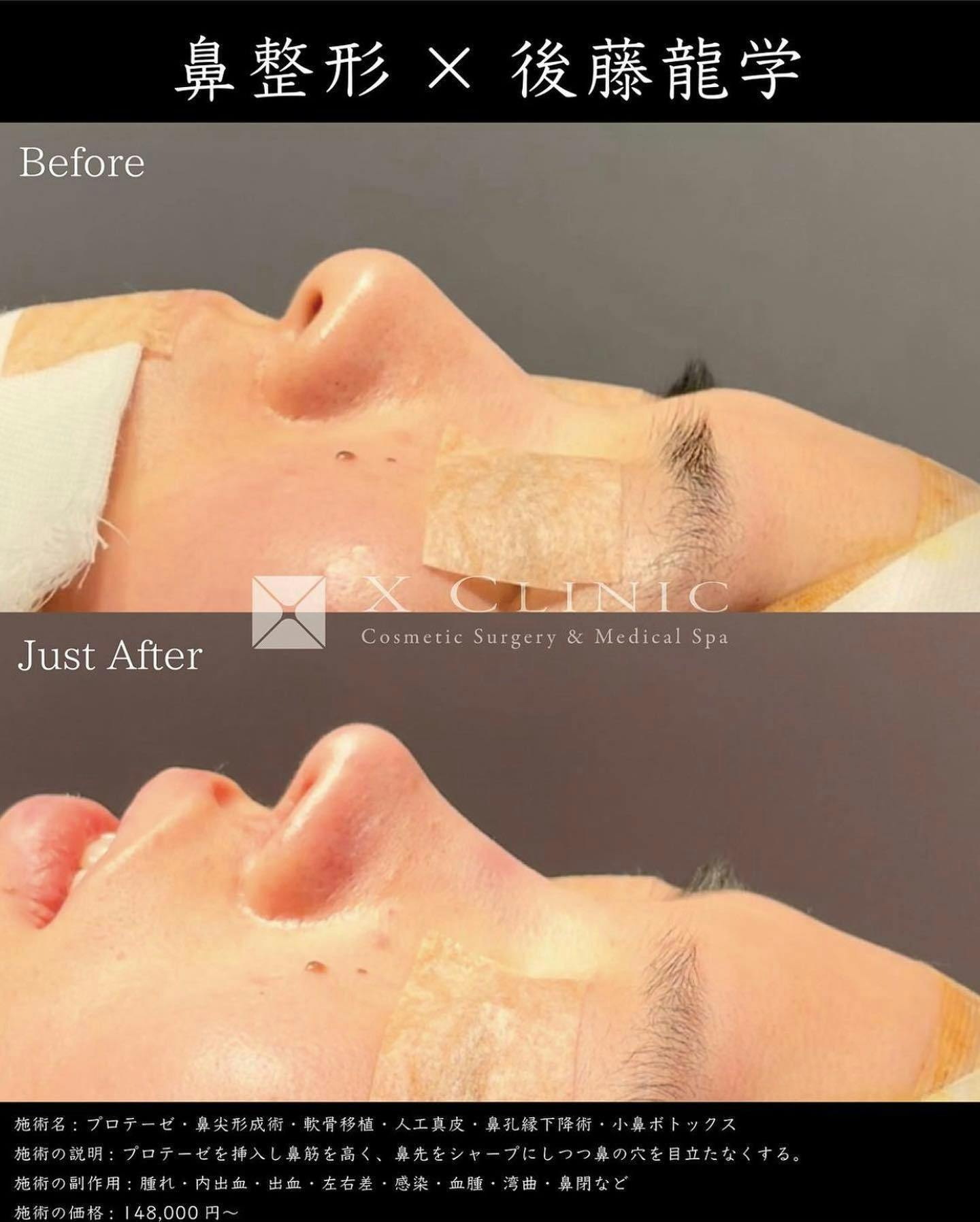 【女性・鼻】プロテーゼ 鼻尖形成3D法 軟骨移植 人工真皮 鼻孔縁下降術 小鼻ボトックス(アラガン)_before_aftar