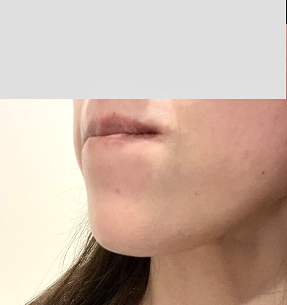 目尻・目の下ボトックス注射｜ボツリヌストキシン注射（1部位）｜目尻のシワ｜1カ月保証 | 横浜TAクリニック, image size:920x979