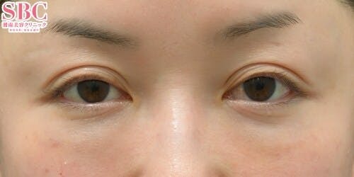 【女性・目元】目の下の切らないクマ・たるみ（ふくらみ）取り、ナチュラル脂肪注射コンデンスリッチ、ナチュラル脂肪注射ナノリッチ_1week