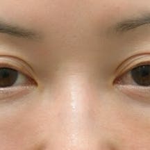 【女性・目元】目の下の切らないクマ・たるみ(ふくらみ)取り、ナチュラル脂肪注射コンデンスリッチ、ナチュラル脂肪注射ナノリッチ_1week