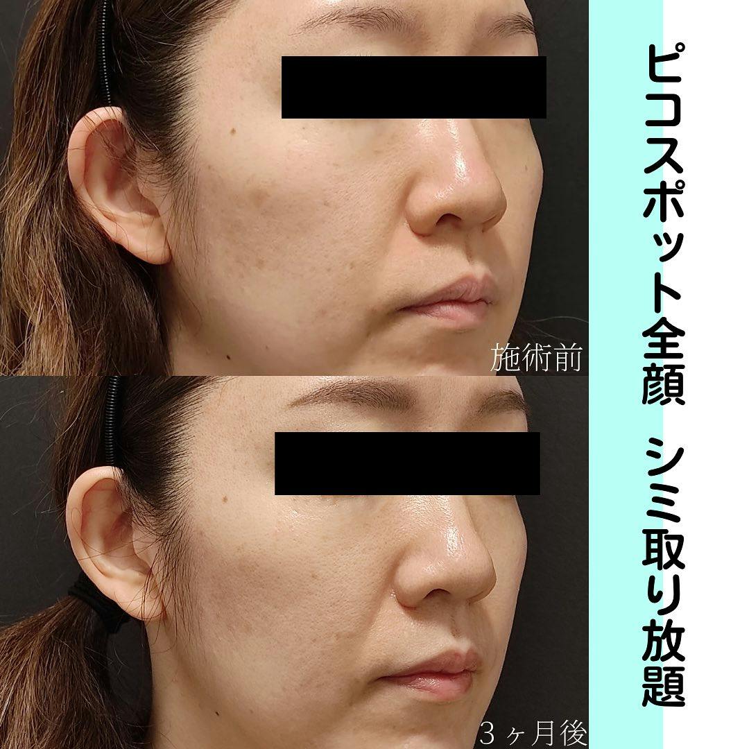 【女性・頬】ピコスポット全顔シミ取り放題_before_aftar