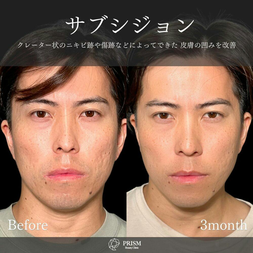 【30代男性・顔のニキビ跡】サブシジョン＋ヒアルロン酸注射_before_aftar