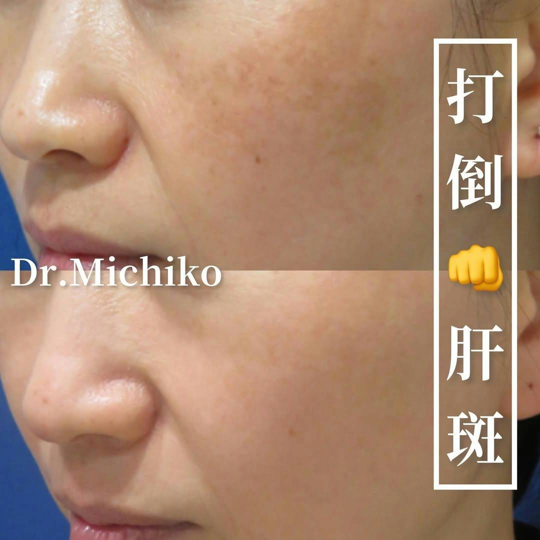 フェミークリニック 池袋院_before_aftar