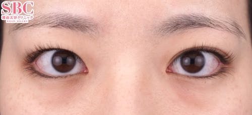 【20代女性・目元】クイックコスメティーク・トリプルNeo_before