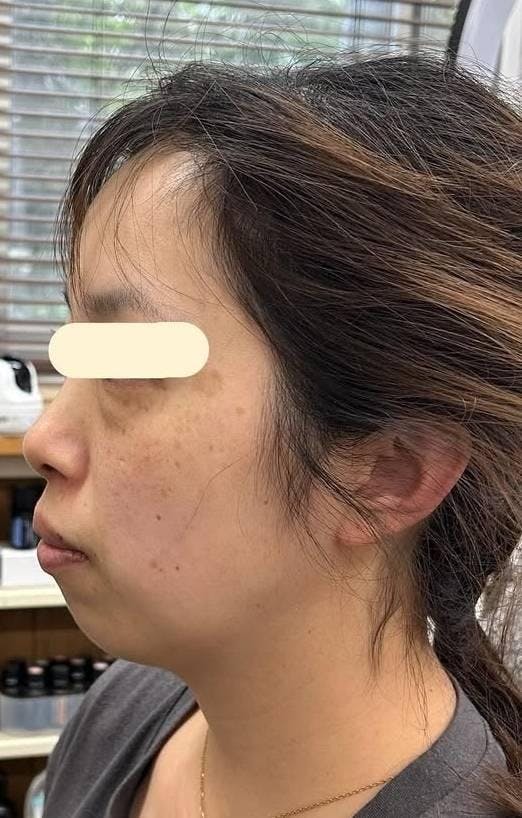 東京美容外科 新宿院でHIFU（ハイフ）：ウルトラセルQプラス（HIFU）リフトアップ ［ドット］を受けたまつげちゃんさんの写真