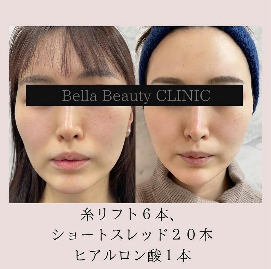 【女性・たるみ】糸リフト　フェイスライン_before_aftar