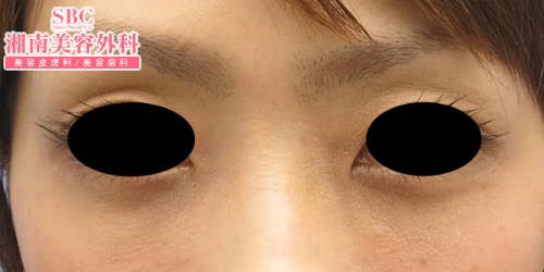 【女性・目元】目の下の切らないクマ・たるみ（ふくらみ）取り・ナチュラル脂肪注射コンデンスリッチ・ナチュラル脂肪注射_aftar