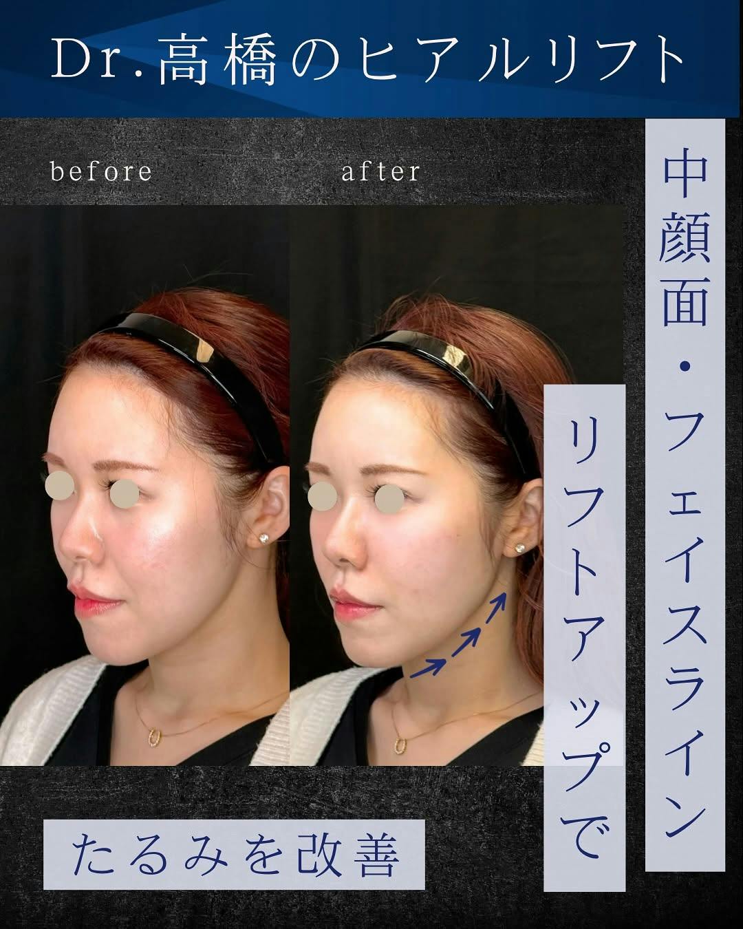 【女性・たるみ】ヒアルロン酸_before_aftar