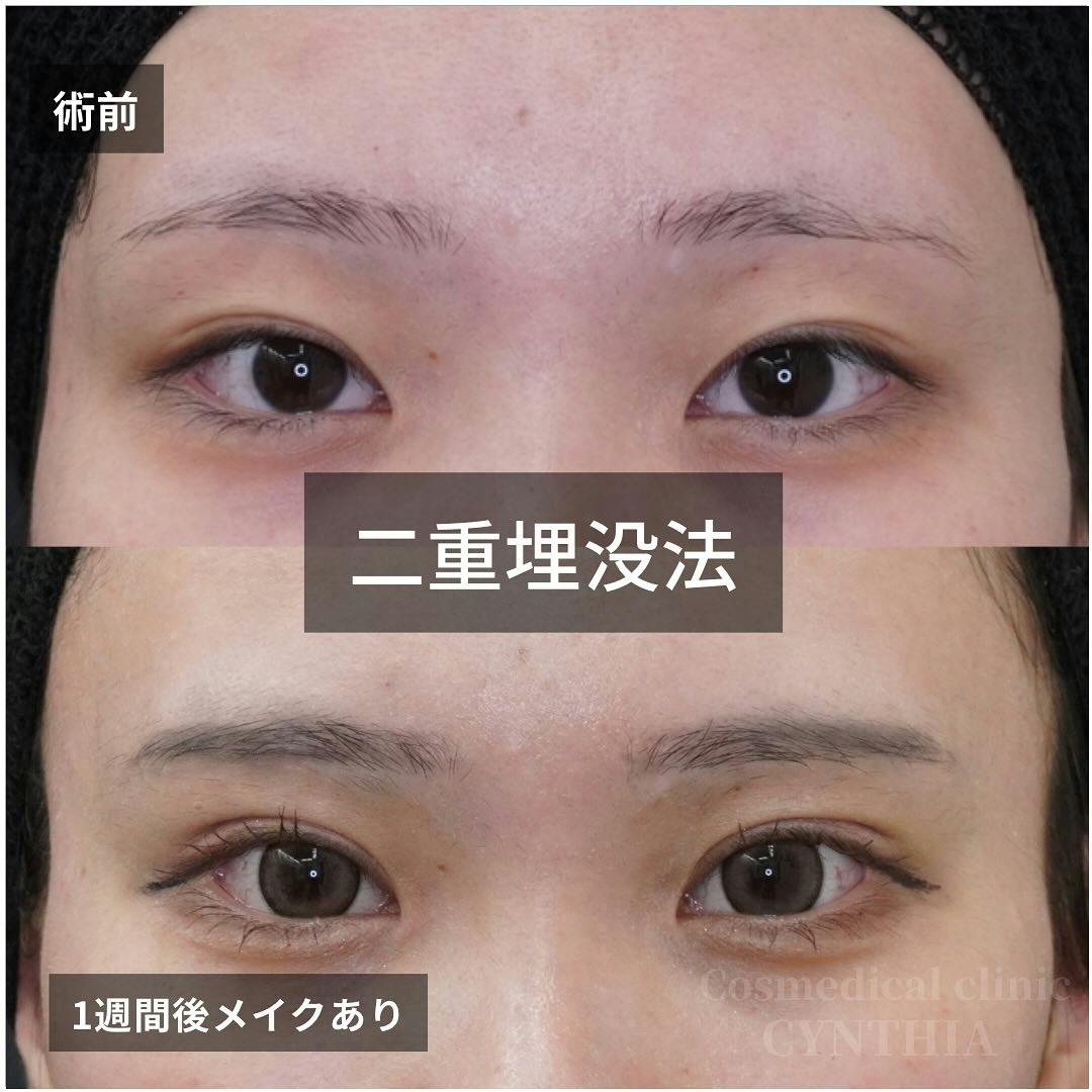 【女性・目元】二重埋没法_before_aftar