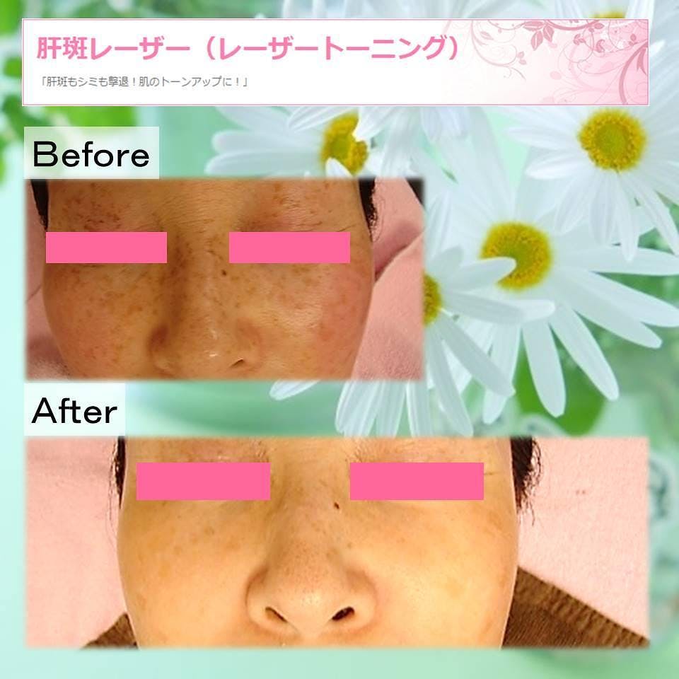 【50代女性・シミ】肝斑レーザー_before_aftar